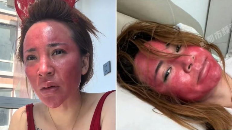 Uruhu rw’Isura rwarangiritse kubera kumara imyaka 22 adakuraho maquillage