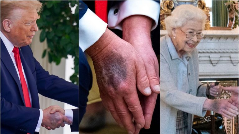 Menya Indwara Trump Arwaye Ishobora Kumuhitana. Umwamikazi Elizabeth II Yahuye Nayo Mbere yo Gupfa